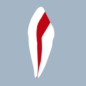 3343-01-o - Canine mandibulaire avec cavité d’accès réalisée (coupe) - RightNao