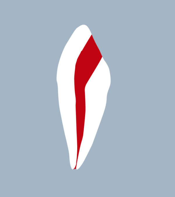 3343-01-o - Canine mandibulaire avec cavité d’accès réalisée (coupe) - RightNao