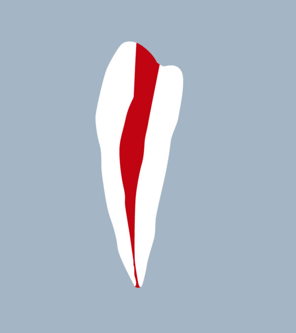 3444-01-o - First mandibular premolar with access cavity performed (cut) - RightNao