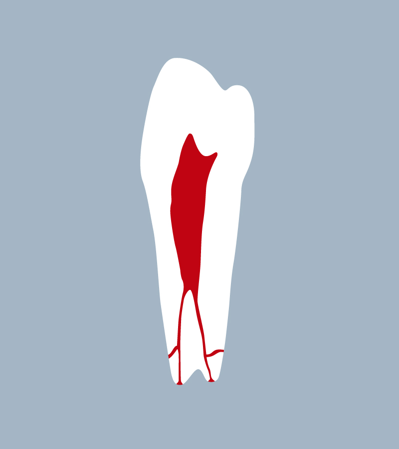 3545-02-2PMB - Seconde prémolaire mandibulaire (coupe) - NaodetntEvolution