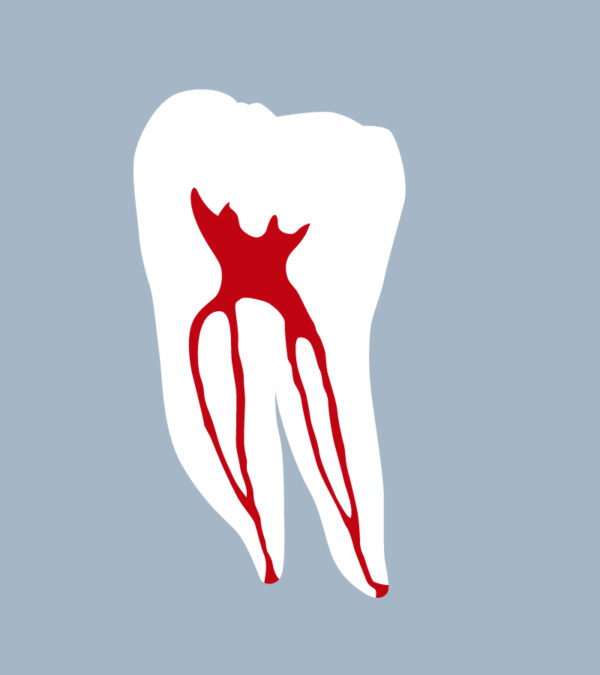 3646-01-1MMB - First mandibular molar (cut) - RightNao