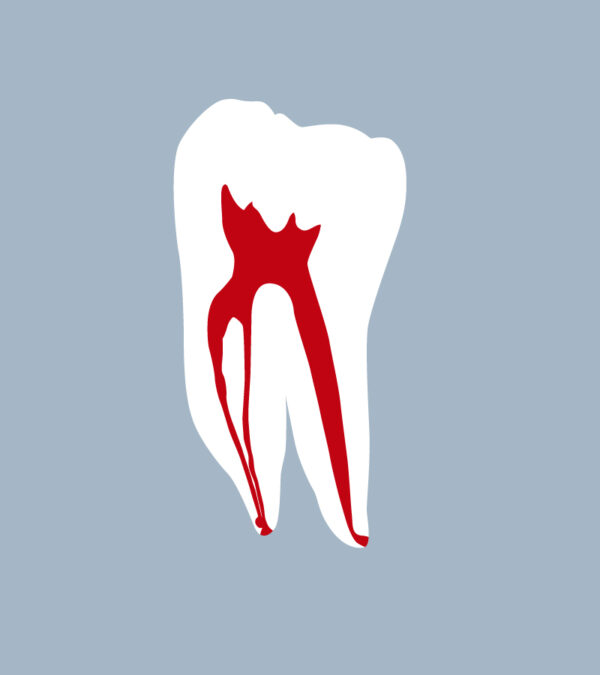 3646-02-1MMB - First mandibular molar (cut) - RightNao