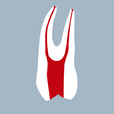 1424-01-o-1PMX - Première prémolaire maxillaire avec cavité d’accès réalisée (coupe) - RightNao