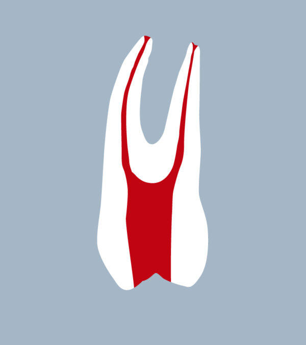 1424-01-o-1PMX - Erster Oberkiefer-Prämolar mit Zugangshöhle durchgeführt (schnittig) - RightNao