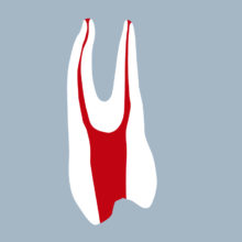 1424-02-o-1PMX - Première prémolaire maxillaire avec cavité d’accès réalisée (coupe) 1424-02-o-1PMX - Première prémolaire maxillaire avec cavité d’accès réalisée (coupe) - RightNao