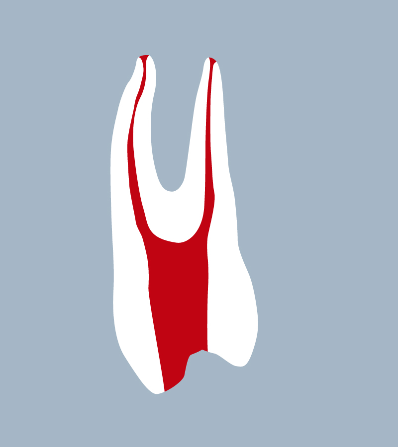 1424-02-o-1PMX - Première prémolaire maxillaire avec cavité d’accès réalisée (coupe) - RightNao