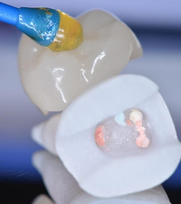 Nouveautés 2020 - Bloc Endo-Resto - Couronne, détail 3 - Copyright RightNao