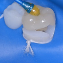 Nouveautés 2020 - Bloc Endo-Resto - Couronne, détail 4 - Copyright RightNao