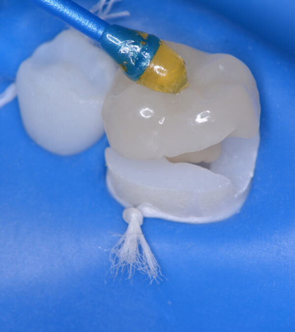 Nouveautés 2020 - Bloc Endo-Resto - Couronne, détail 4 - Copyright RightNao