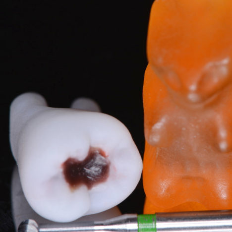 Nouveautés 2020 - Dent cariée, vue 3 - Copyright RightNao