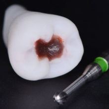 Nouveautés 2020 - Dent cariée, vue 1 - Copyright RightNao