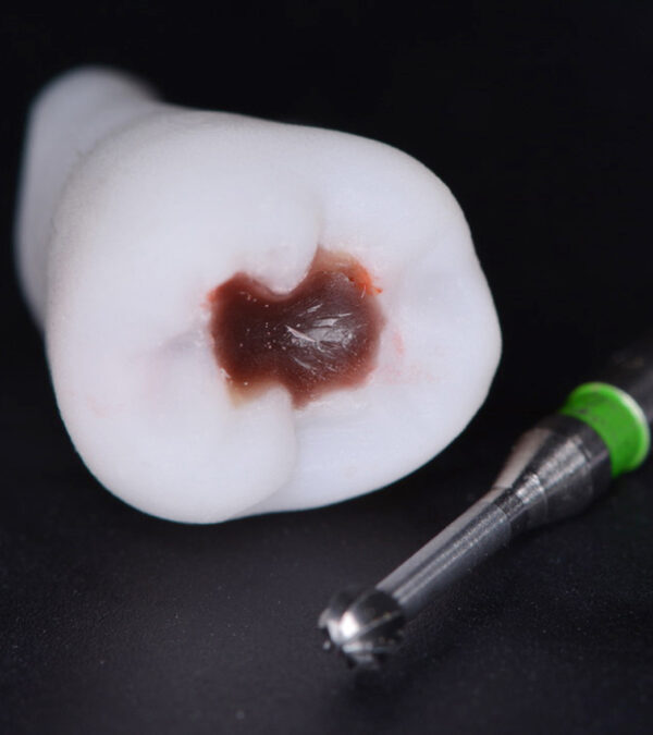 Nouveautés 2020 - Dent cariée, vue 1 - Copyright RightNao