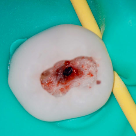 Nouveautés 2020 - Dent cariée point de saignement - Copyright RightNao