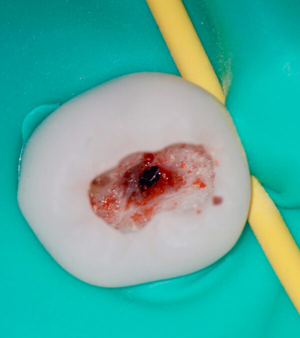 Nouveautés 2020 - Dent cariée point de saignement - Copyright RightNao