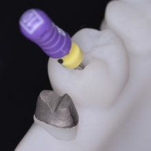 Nouveautés 2020 - Kit Endo Prothèse sans Couronne - Copyright RightNao