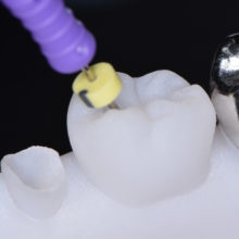 Nouveautés 2020 - Kit Endo Prothèse sans Inlay Core - Copyright RightNao