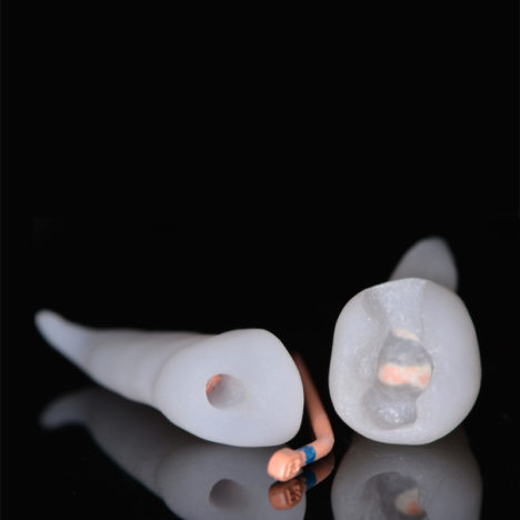 Nouveautés 2020 - Retraitement canalaire - Molaire & canine - Copyright RightNao