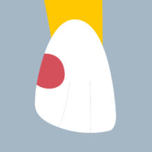 12-D - Dent cariée - Incisive latérale supérieure droite, tracés - Copyright RightNao