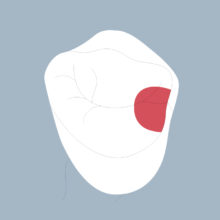 14-M - Dent cariée - Première prémolaire supérieure droite, tracés - Copyright RightNao