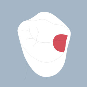 14-M - Dent cariée - Première prémolaire supérieure droite, tracés - Copyright RightNao