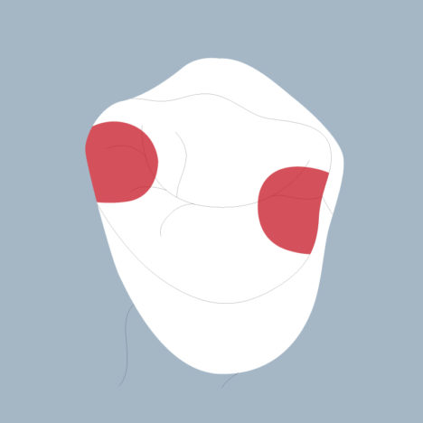 15-MDS - Dent cariée - Seconde prémolaire supérieure droite, tracés - Copyright RightNao