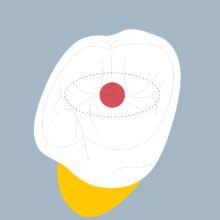 16-OCS - Dent cariée - Premiere molaire supérieure droite, tracés - Copyright RightNao