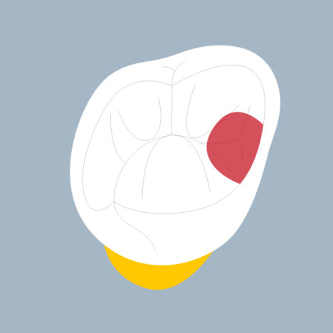 17-M - Dent cariée - Seconde molaire supérieure droite, tracés - Copyright RightNao