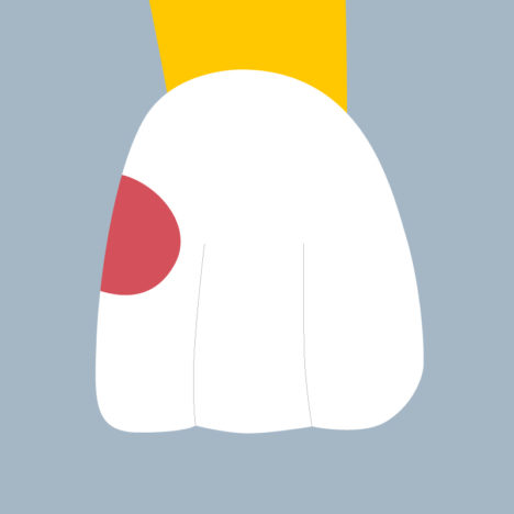 21-M - Dent cariée - Incisive centrale supérieure gauche, tracés - Copyright RightNao