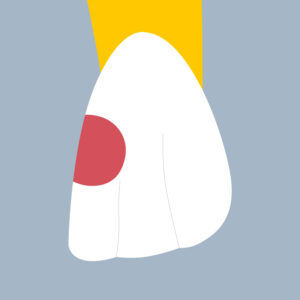 22-M - Dent cariée - Incisive latérale supérieure gauche, tracés - Copyright RightNao