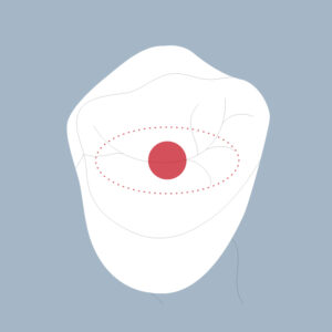 24-OCS - Dent cariée - Première prémolaire supérieure, tracés - Copyright RightNao