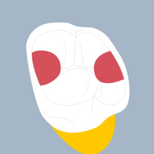 26-MOD - Dent cariée - Premiere molaire supérieure gauche, tracés - Copyright RightNao