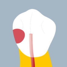 34-MP - Dent cariée - Premiere prémolaire inférieure gauche, tracés - Copyright RightNao