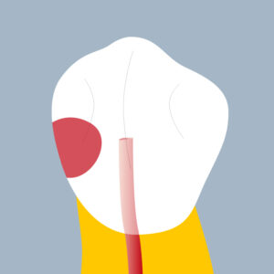 34-MP - Dent cariée - Premiere prémolaire inférieure gauche, tracés - Copyright RightNao