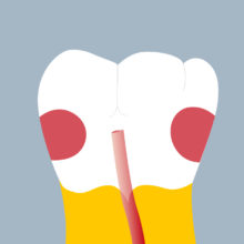 36-MDP - Dent cariée - Premiere molaire inférieure gauche, tracés - Copyright RightNao