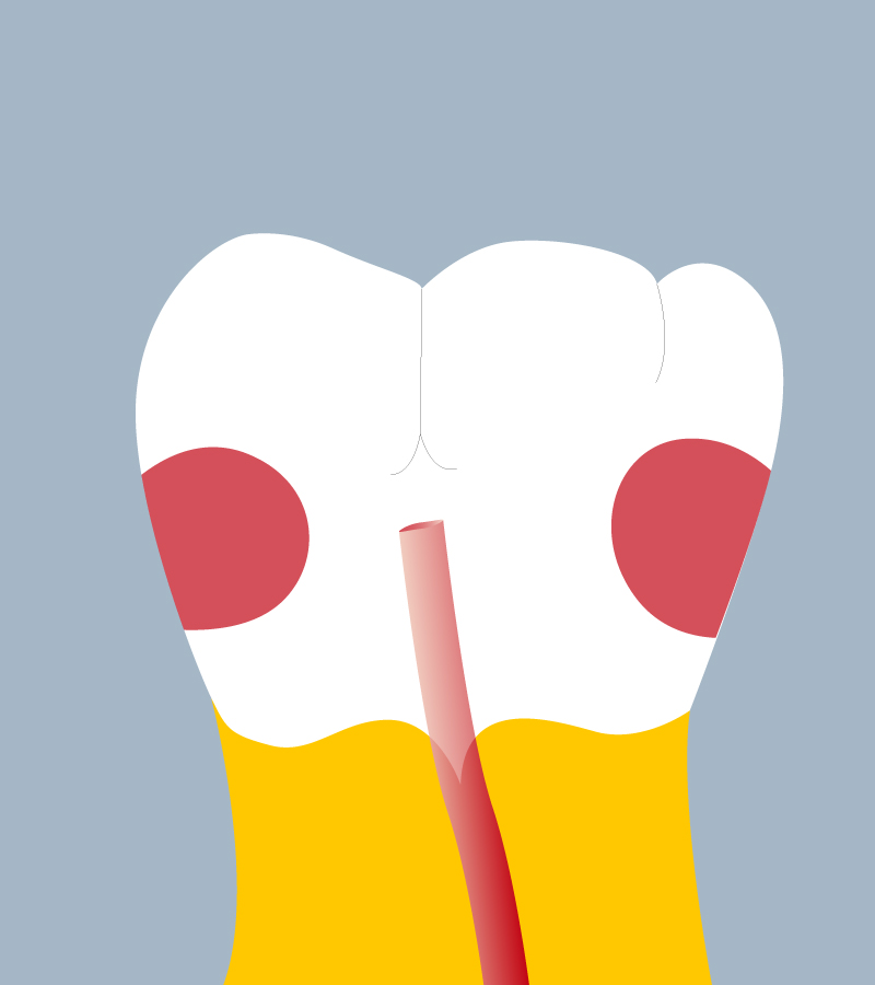 36-MDP - Diente Cario - Primer molar inferior izquierdo, trazas - Copyright RightNao