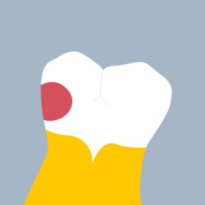 37-M - Dent cariée - Seconde molaire inférieure gauche, tracés - Copyright RightNao