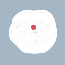 46-OCS - Dent cariée - Premiere molaire inférieure droite, tracés - Copyright RightNao