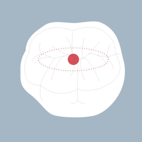 46-OCS - Dent cariée - Premiere molaire inférieure droite, tracés - Copyright RightNao