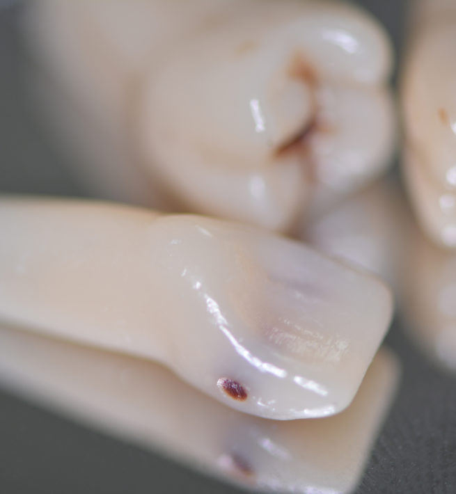 DCA - Visuel dents cariées, détail incisive - Copyright RightNao