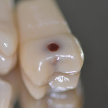 DCA - Visuel dents cariées, détail prémolaire - Copyright RightNao