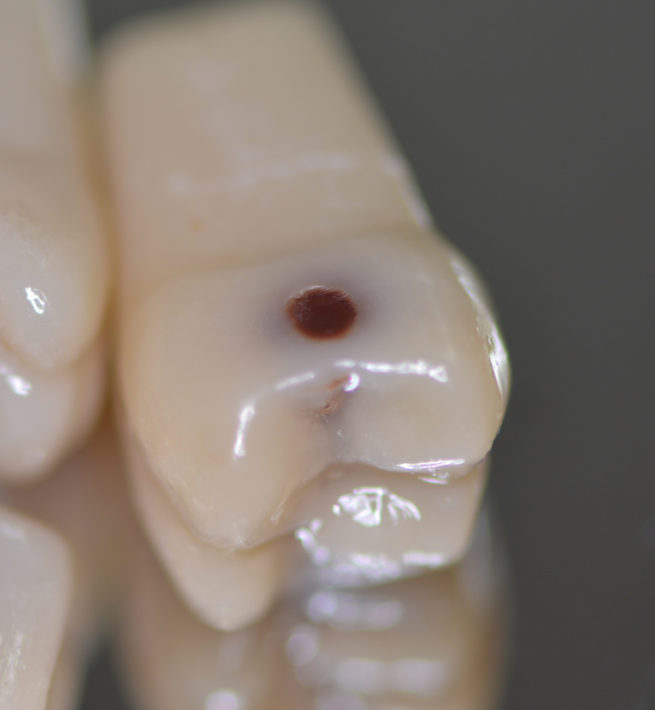 DCA - Visuel dents cariées, détail prémolaire - Copyright RightNao