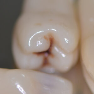 DCA - Visuel dents cariées, détail molaire - Copyright RightNao