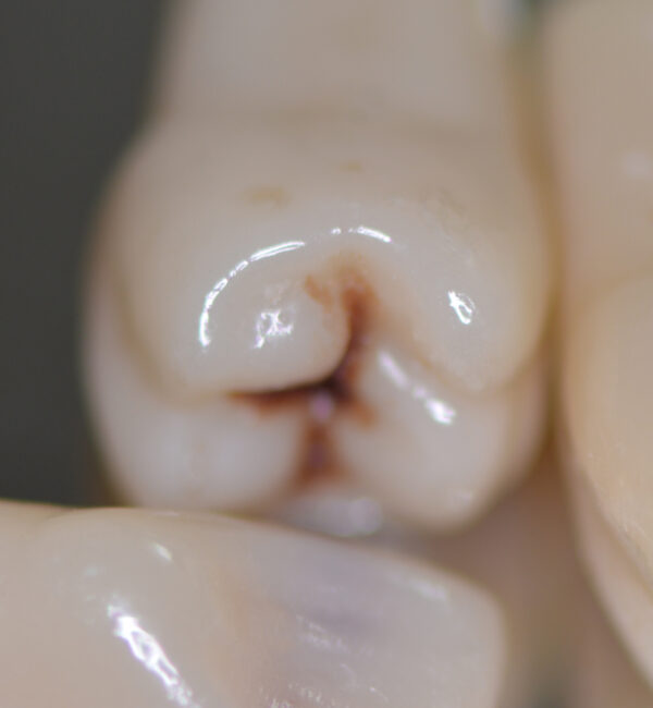 DCA - Visuel dents cariées, détail molaire - Copyright RightNao